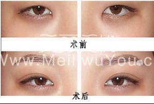全切双眼皮和开眼角手术一起做怎样