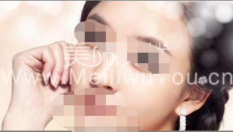 什么是韩式微创割双眼皮？