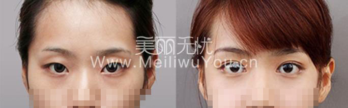 权威专家描述：普遍的割开法双眼皮整形难题
