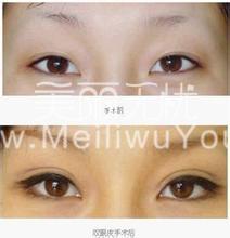 你的割双眼皮是不是取得成功