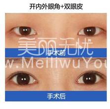 双眼皮手术：双眼皮让彩妆产品变简易