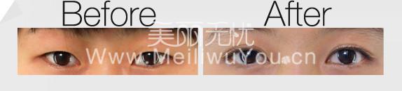 埋线双眼皮整形美容的修补時间要多长时间？