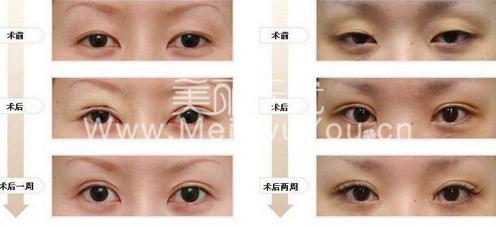 韩式切开双眼皮的引诱优势
