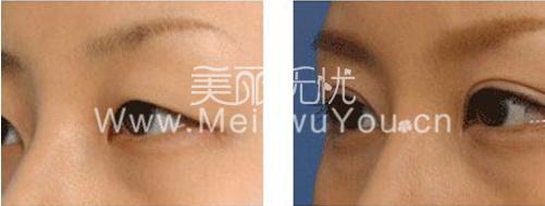 全切双眼皮整形手术后你需要做些哪些？
