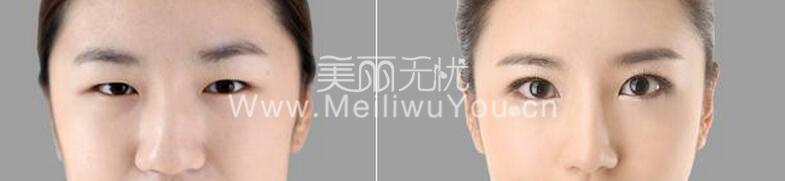 双眼皮整形增添你的自信心美！