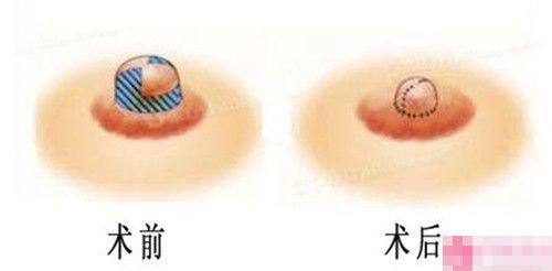 注射肉毒素的康复治疗時间
