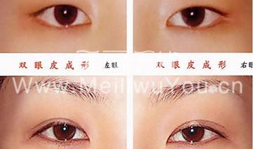有关埋线双眼皮整形美容的十大顾虑！