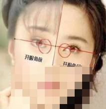 开眼角手术 打造出引诱双眸