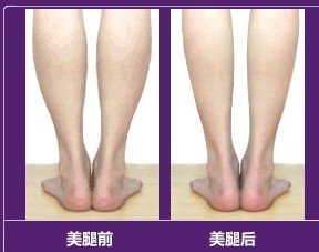 瘦小腿肚的快速方式