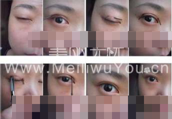 韩式微创双眼皮的手术重中之重主要表现