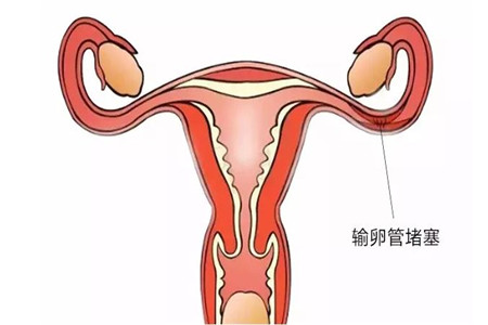 女人不孕症缠身的四个元凶