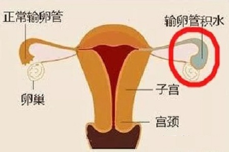 这5个症状表示女性可能是出现子宫异位的情况