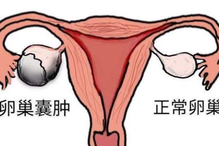 女人导致卵巢囊肿的三个原因